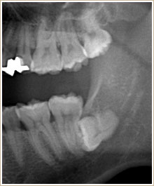 CT画像　顎の親不知の歯が横向きになって顎骨の中に深く埋まっている