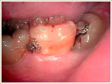 矯正抜歯の写真