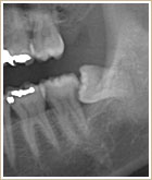 矯正抜歯のCT画像