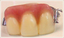 治療を受ける前の義歯