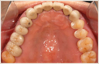 上顎に冠を装着した写真
