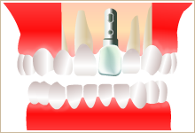 欠損部にインプラントを埋入し、人口の歯を単独で装着したイラスト