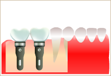 必要な本数のインプラントを埋入し、それぞれ単独で治療するか、インプラント同士を連結したブリッジにしたイラスト