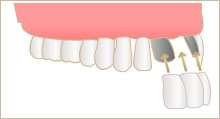 通常のブリッジは図のように歯を削りこんで被せる