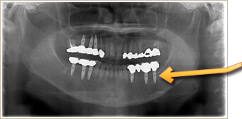 インプラントのレントゲン画像