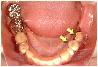 義歯を入れていない状態　下顎
