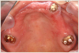 治療後の義歯を外した状態