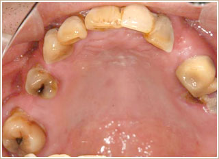 インプラント治療前　上顎写真
