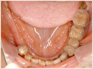 インプラント治療後　下顎写真