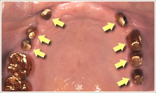 ７本の上顎インプラント（に支台部を取り付けたところ
