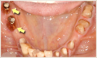 ２本の下顎インプラントに支台部を取り付けたところ