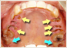 歯牙移植前の確認（移植先は抜去済）の写真