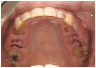 歯牙移植前の写真