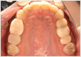 歯牙移植後の写真