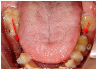 歯とむし歯の処置をした後の写真　矯正治療をするための説明