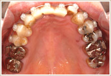 上・下顎には歯列矯正を行い、期間は7ヶ月で終了