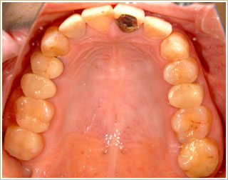 矯正治療後　上顎