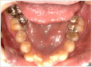 矯正治療前　下顎