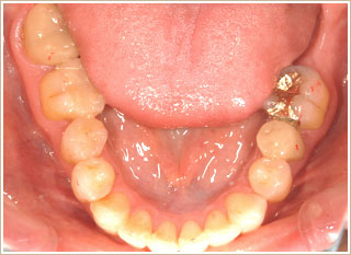 矯正治療後　下顎