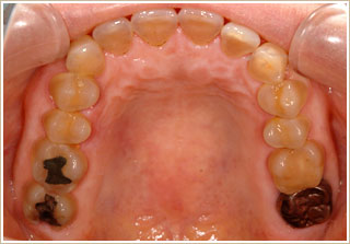 矯正治療前　上顎