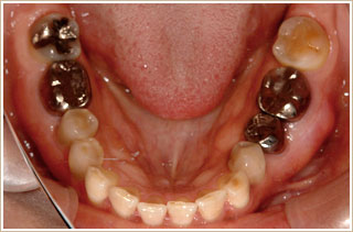 矯正治療前　下顎