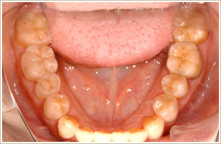 矯正治療後　下顎