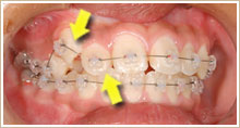 矢印が歪んだ歯列の部分