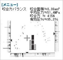 オクルーザーのデータ　噛み合わせ調整後