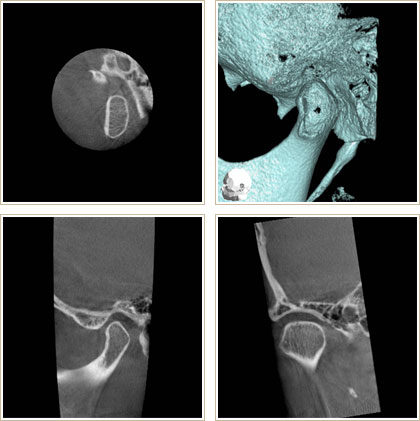顎関節をＣＴで撮影したところ　4方向スライス画像