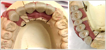 模型上でセラミックの冠を作製したところ