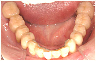審美補綴治療後　下顎