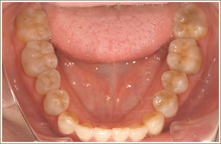 審美補綴治療後　下の奥歯