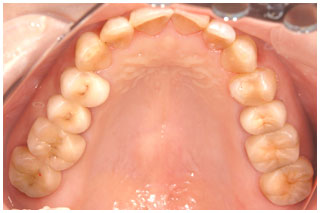 審美補綴治療後　上の奥歯