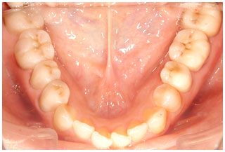 審美補綴治後前　下の奥歯