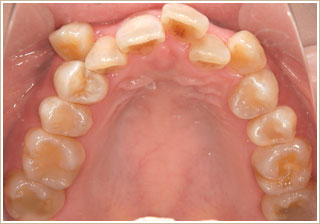 歯列矯正治療前　上顎
