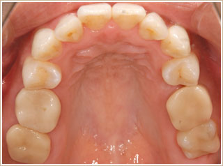 クリアブラケットを用いた矯正　治療後　上顎