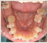 クリアブラケットを用いた矯正　3ヶ月　下顎