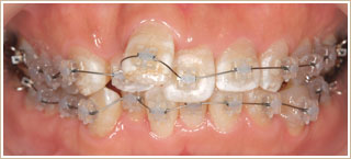 クリアブラケットを用いた頬側矯正