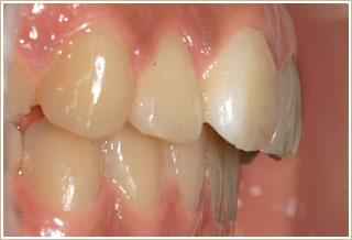 開口だった時の矯正　治療後　側面