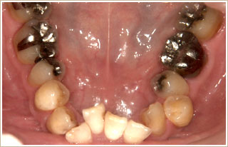 補綴治療を併せて行った時の矯正　治療前　下顎