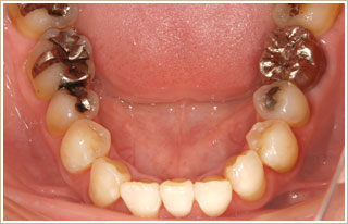 補綴治療を併せて行った時の矯正　治療後　下顎