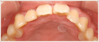 マウスピースによる矯正　治療前　上顎