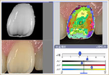 歯の色を詳細に解析診断しているところ