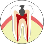 歯の構造　むし歯のイラスト