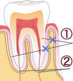 歯の構造のイラスト